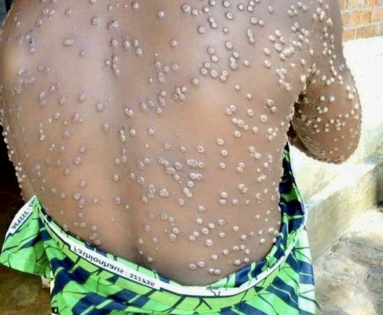 RDC – SANTÉ : L’OMS se mobilise face à la montée inquiétante du mpox en RDC